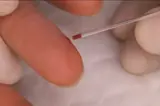 capillary puncture on a finger