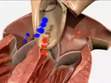 Valvular Disease EKG Assessment