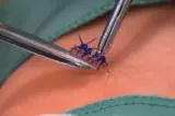 sutures get removed from a patient